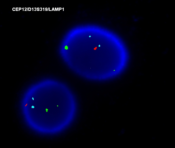 FISH, deletion of chromosome 13 (D13S319)
